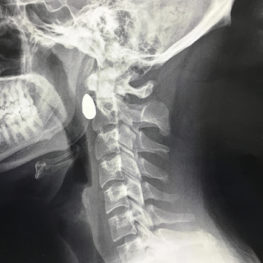 A bullet dodged near a patient's spine